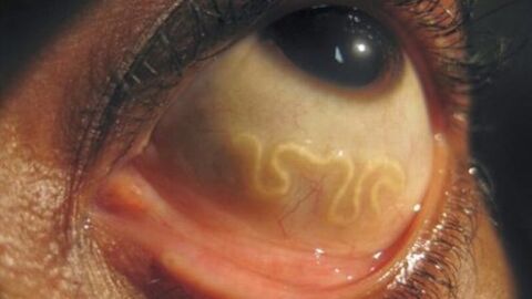 parásito en los ojos humanos