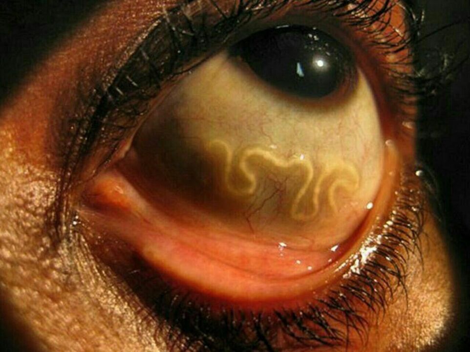 parásitos en el ojo humano