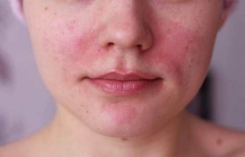 problemas de la piel como un signo de la presencia de parásitos en el cuerpo